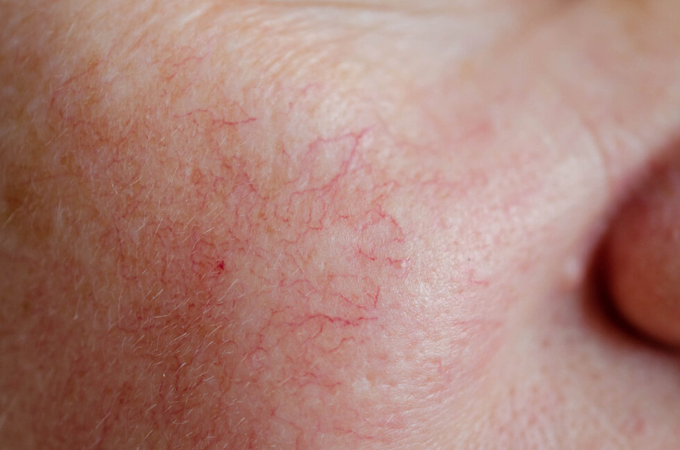 Spider Vein (Thread Vein) Removal